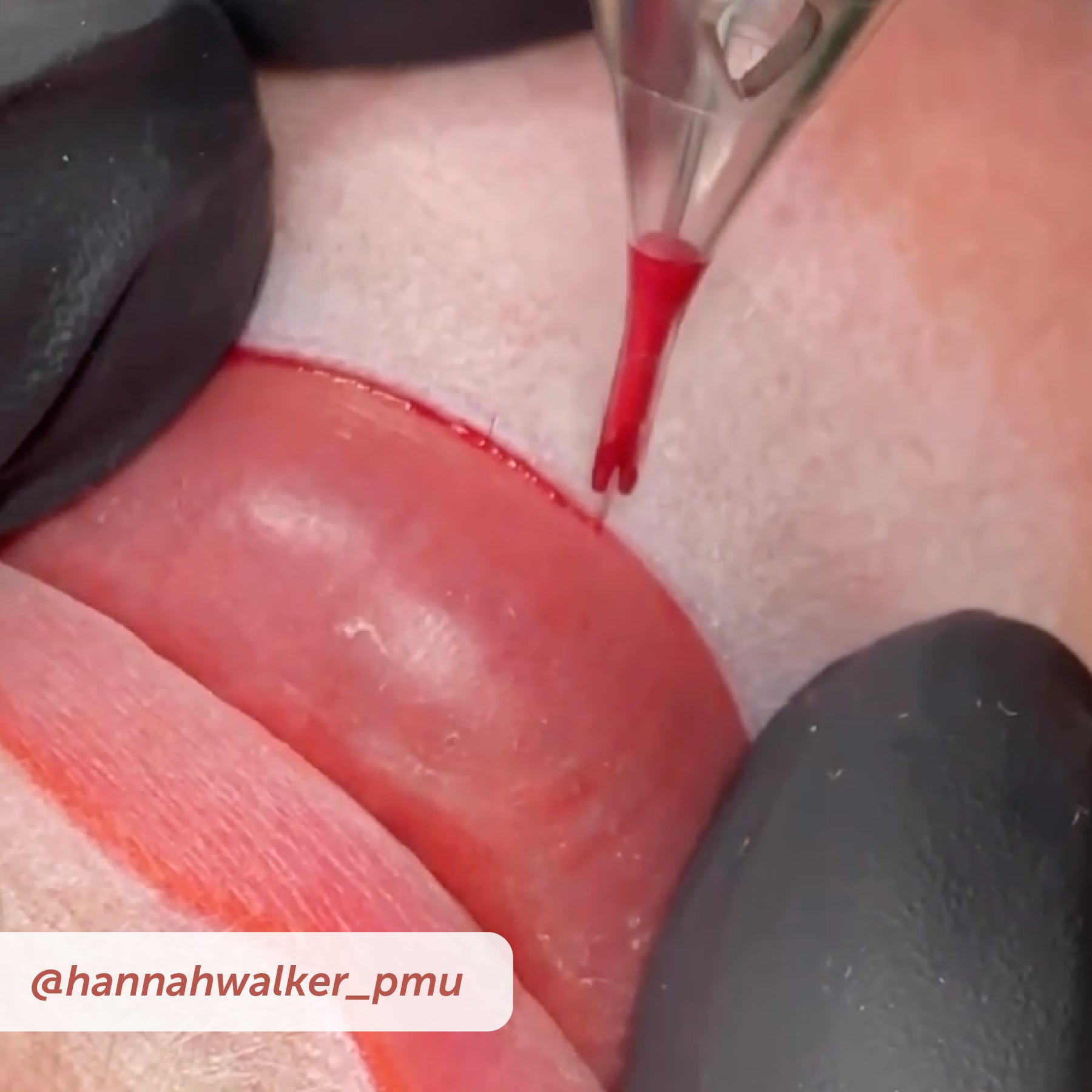 PIXL Needle Cartridges