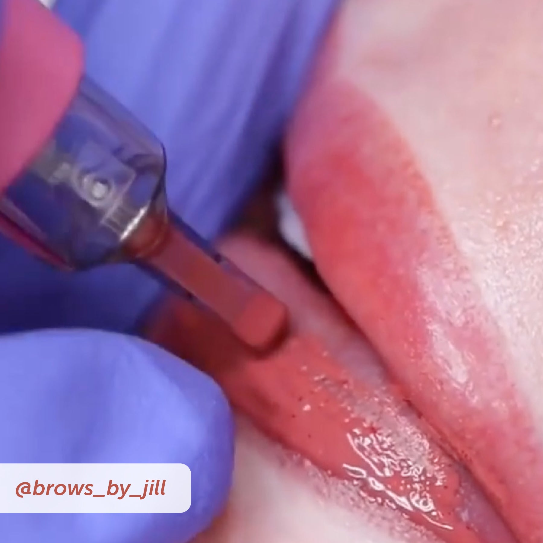 PIXL Needle Cartridges