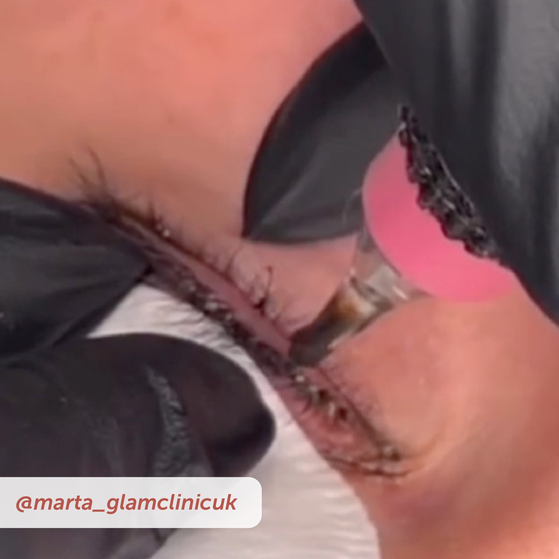 PIXL Needle Cartridges