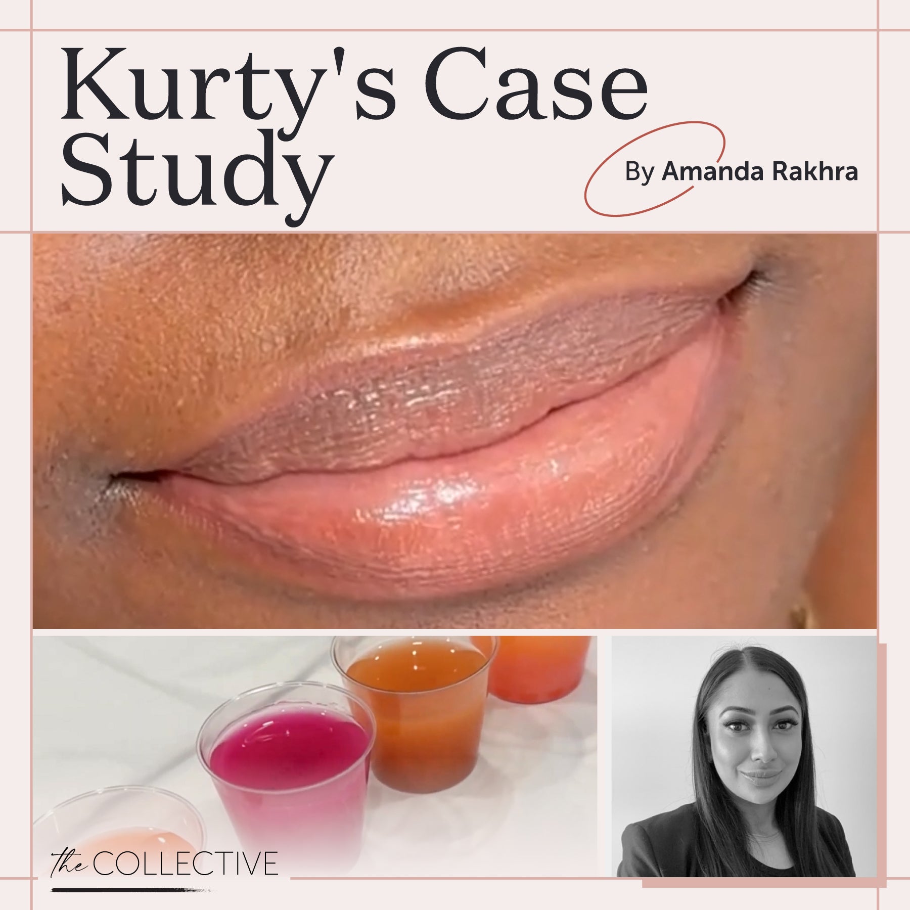 Fitz 6 Dark Lip Neutralization: Kurty’s Case Study