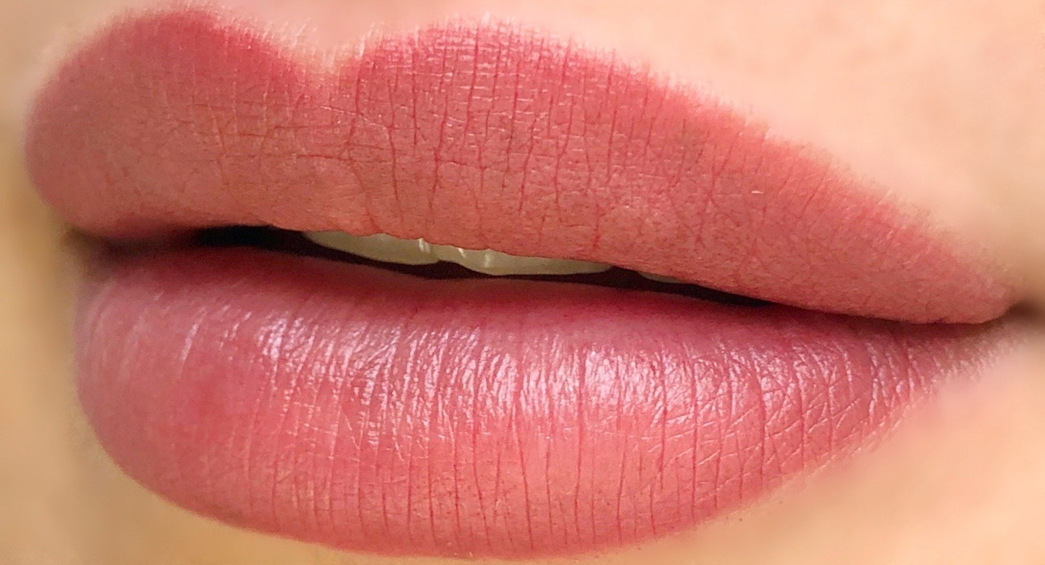 Case Study: Healed Lips on Fitzpatrick 4 Client