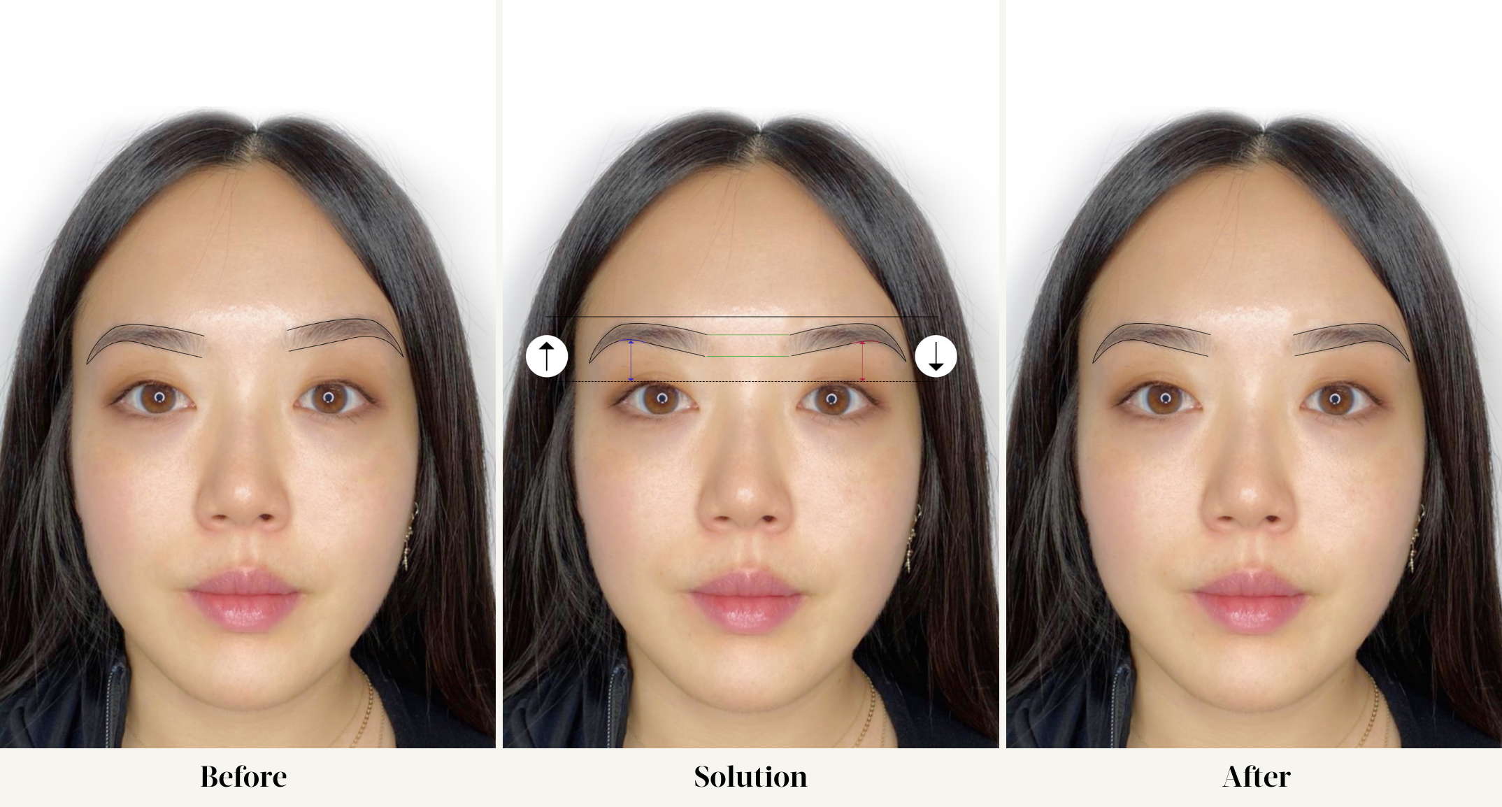 Case Study 1: Brow Mapping Eyebrow Axis Imbalance